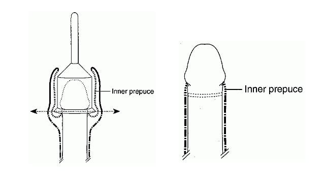 Pharisaic Circumcision